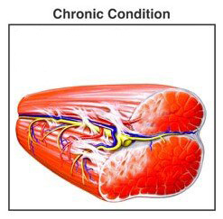 Muscle-Chronic-Condition